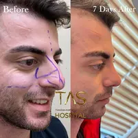 Case Study Number 17 – Male Nose Reshaping