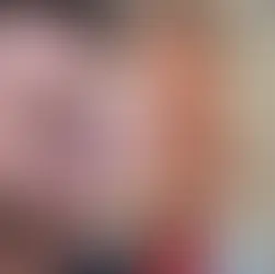 Case Study Number 17 – Male Nose Reshaping