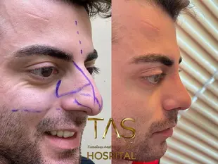 Case Study Number 17 – Male Nose Reshaping