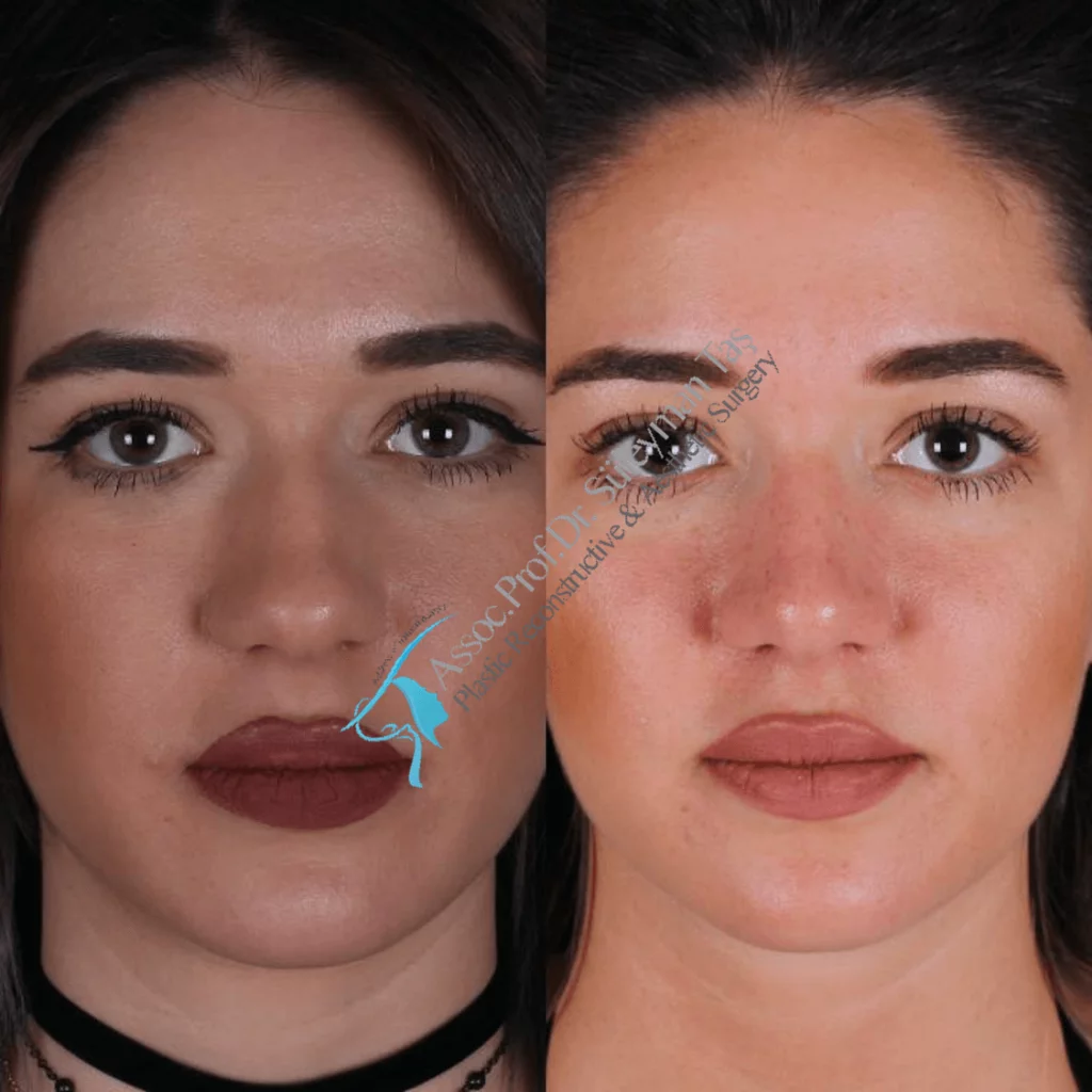 Suleyman Tas Before After Rhinoplasty