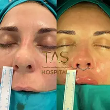 Case Study – Lip Lift