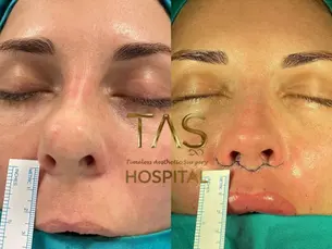 Case Study – Lip Lift