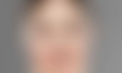Rinoplasti Sonrası Şişlik, Morluk ve Ödem Neden Oluşur?