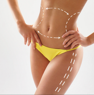 Liposuction for Love Handles