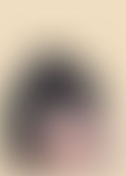 Unshaven Hair Transplant (U-FUE)
