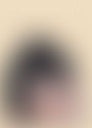 Unshaven Hair Transplant (U-FUE)