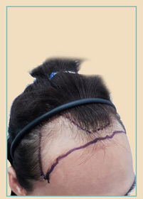 Unshaven Hair Transplant (U-FUE)