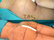 Case Study – Scarless Buttlift