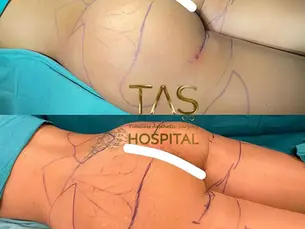 Case Study – Scarless Buttlift