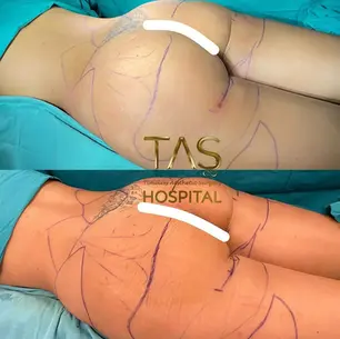 Case Study – Scarless Buttlift