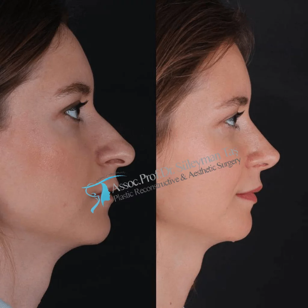 Suleyman Tas Before After Rhinoplasty