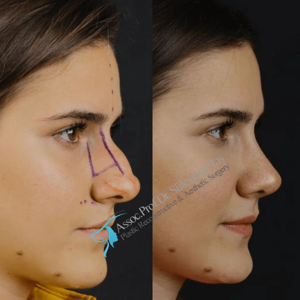 Suleyman Tas Before After Rhinoplasty