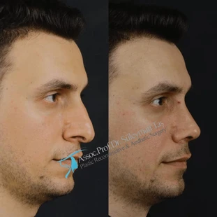 Dr Suleyman Tas Male Profile Rhinoplasty