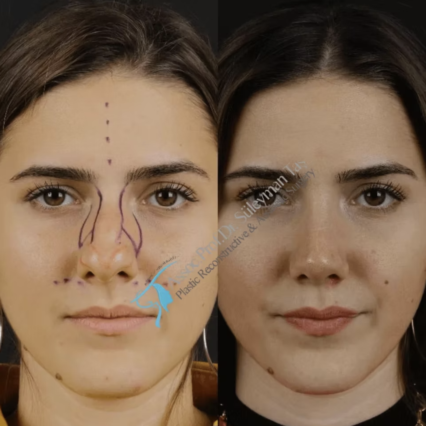Suleyman Tas Ethnic Rhinoplasty Turkey