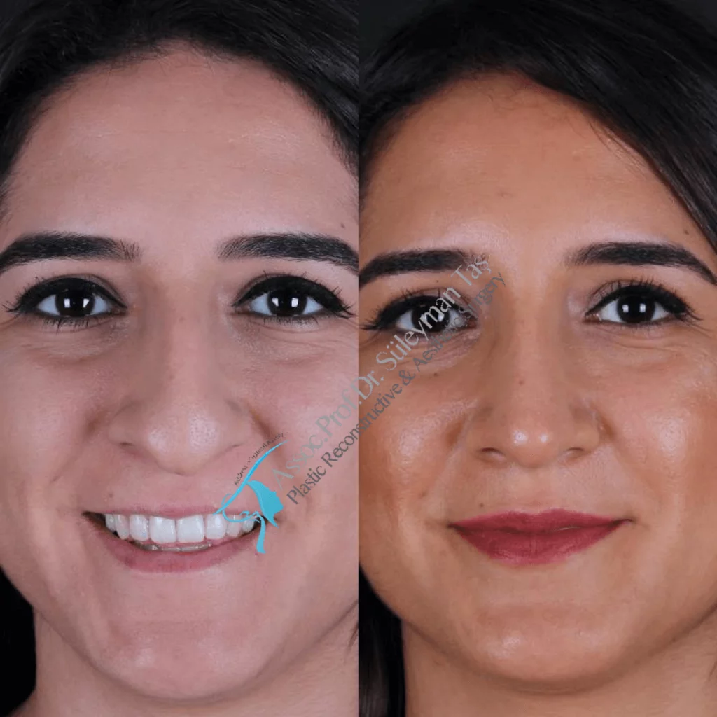 Suleyman Tas Before After Rhinoplasty