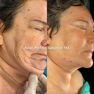 Case Study – Face aesthetics under local anesthesia