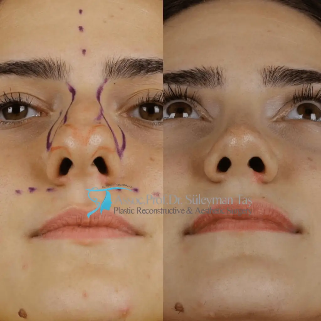 Suleyman Tas Before After Rhinoplasty