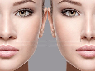 Burun Kanat Cerrahisi Nedir?