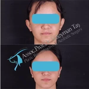 facelift-necklift-foxeyes-ear-surgery-before-and-after-gallery-12.webp