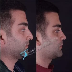 Dr Suleyman Tas Male Nose Reshaping Before After
