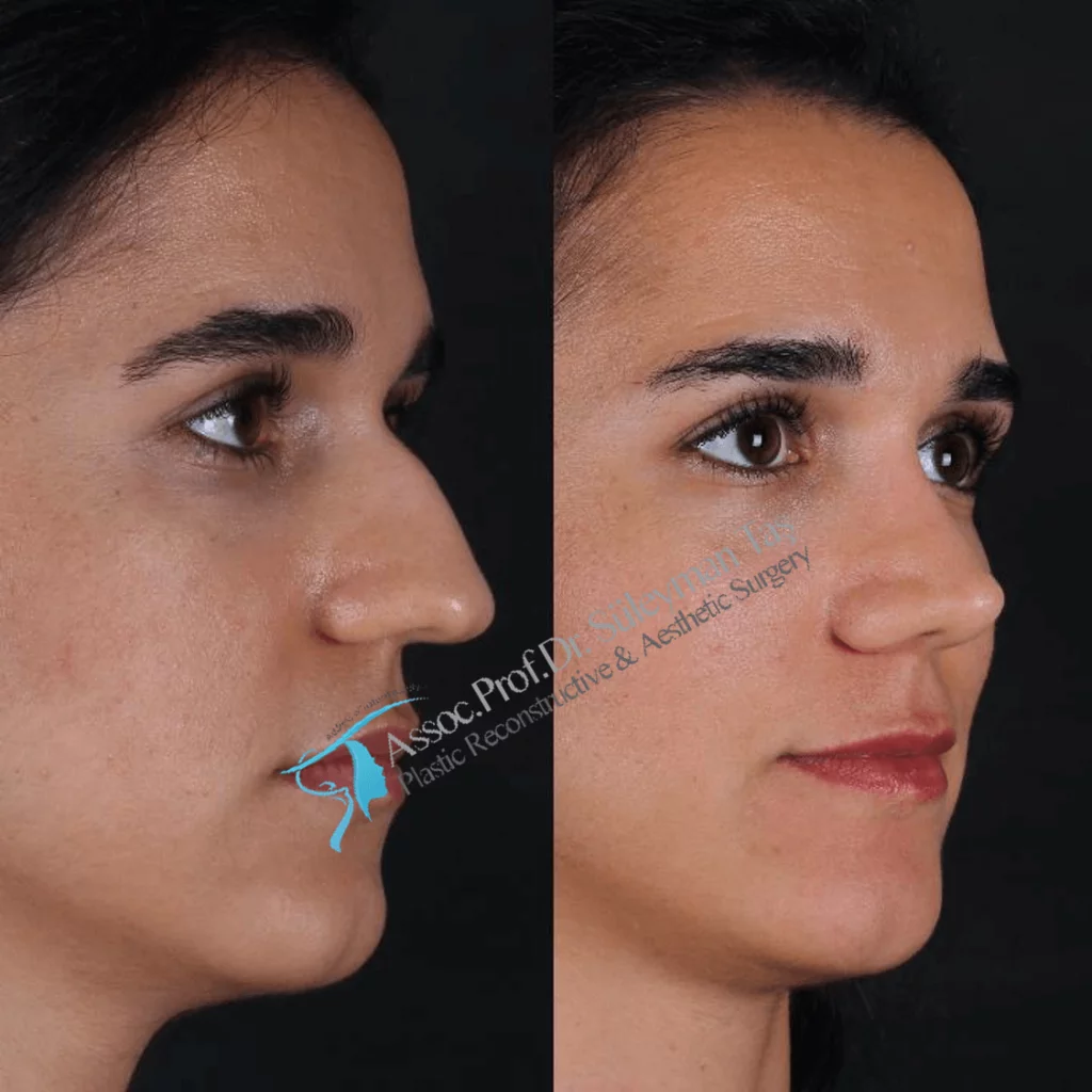 Suleyman Tas Before After Rhinoplasty
