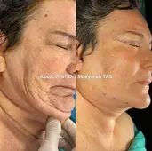 Case Study Number 13 – Face aesthetics under local anesthesia