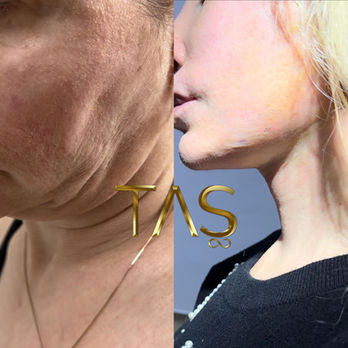 Celebrity plastic surgery before and after – Prof. Dr. Suleyman Tas patient result (photo 18)