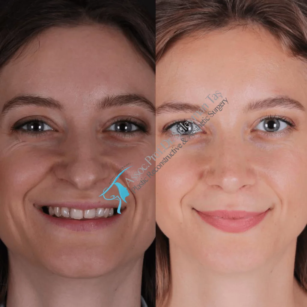 Suleyman Tas Before After Rhinoplasty