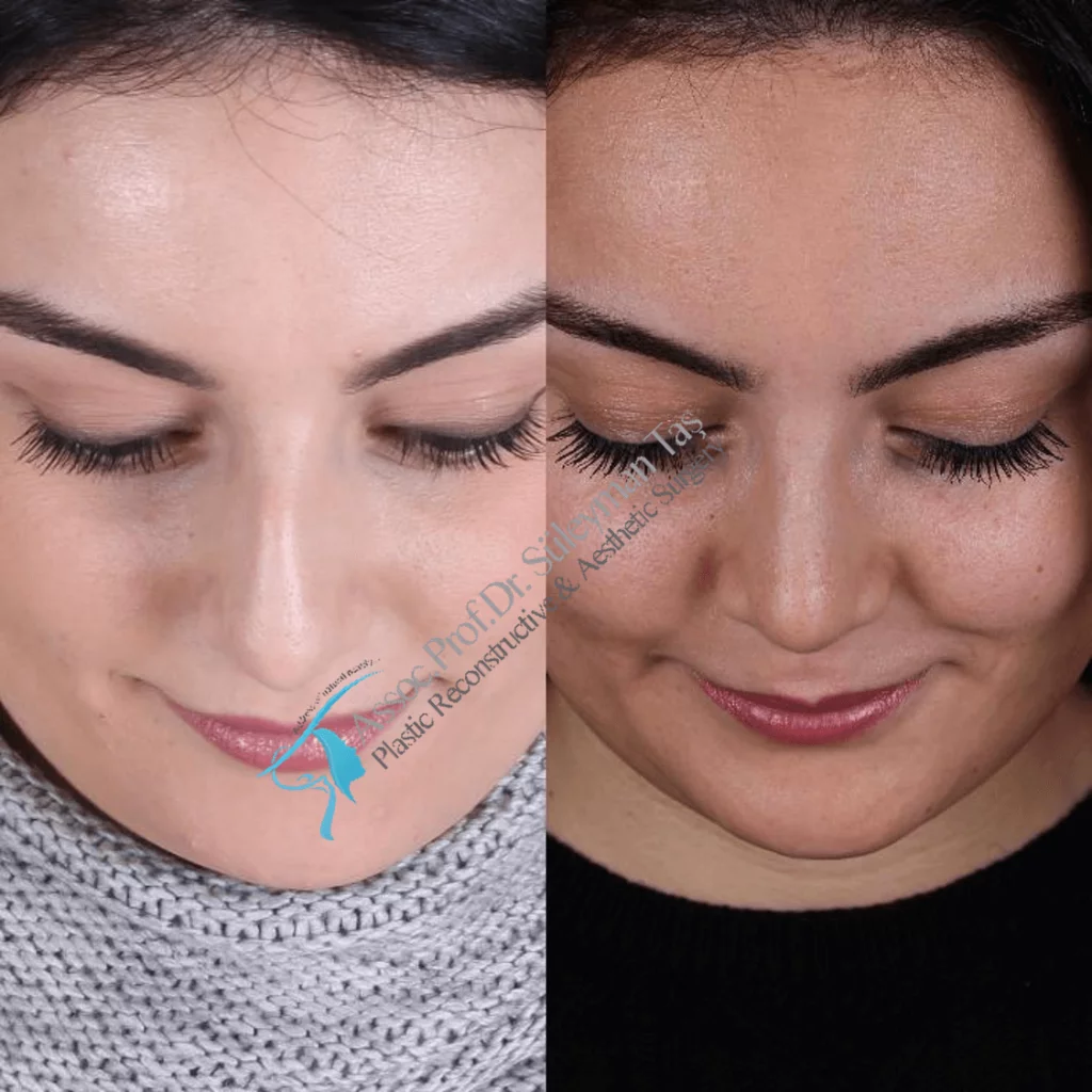 Suleyman Tas Before After Rhinoplasty