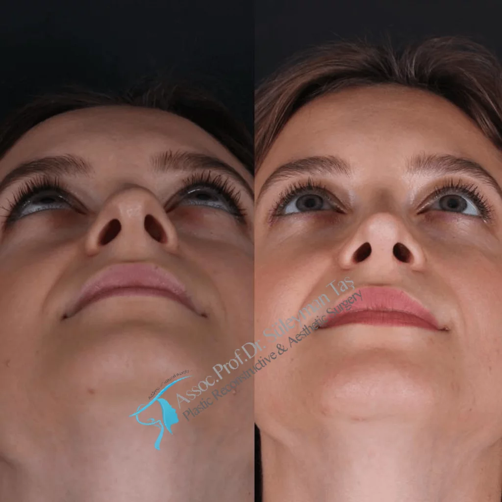 Suleyman Tas Before After Rhinoplasty