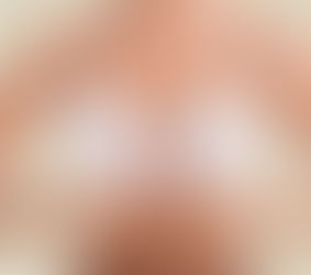 COMPOSITE BREAST AUGMENTATION AESTHETICS