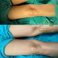 Case Study Number 24 – Legs reshaping with Vaser liposuction