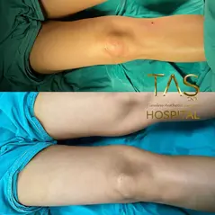 Case Study Number 24 – Legs reshaping with Vaser liposuction