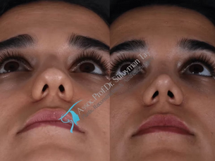 Suleyman Tas Rhinoplasty Before After Results