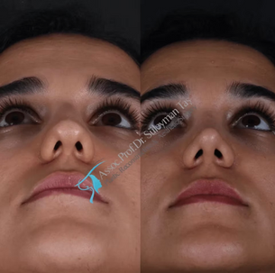 Suleyman Tas Rhinoplasty Before After Results