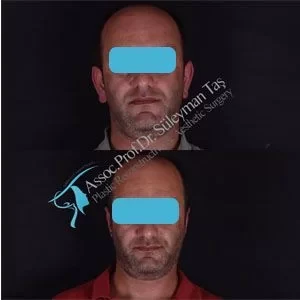 facelift-necklift-foxeyes-ear-surgery-before-and-after-gallery-10 (1).webp