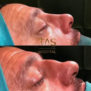 Case Study Number 7 – Bulbous nose rhinoplasty