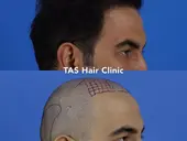Case Study Number 12 – Hair Transplant