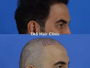 Case Study Number 12 – Hair Transplant