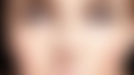 Kapalı Burun Estetiği