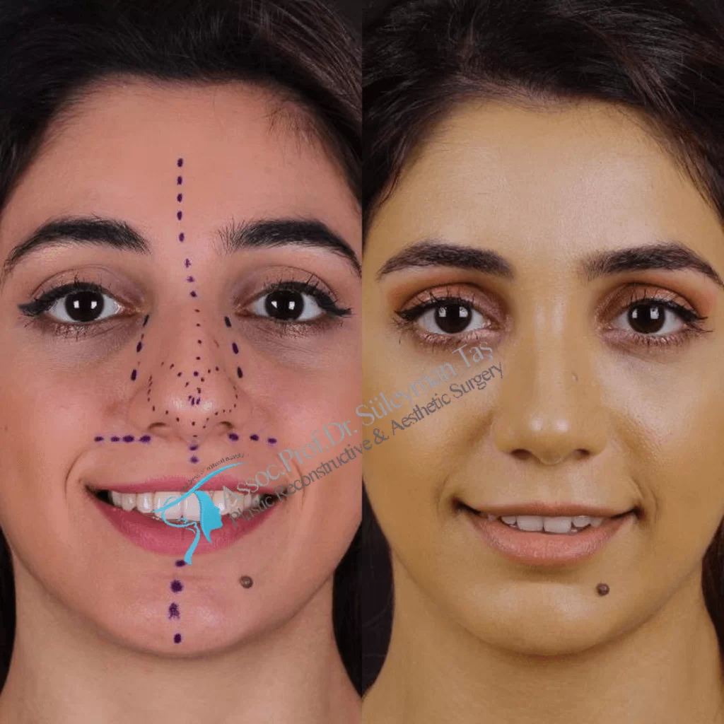 Suleyman Tas Before After Rhinoplasty