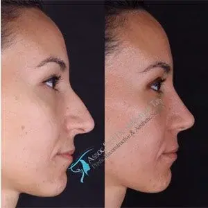 Suleyman Tas rhinoplasty swelling before after