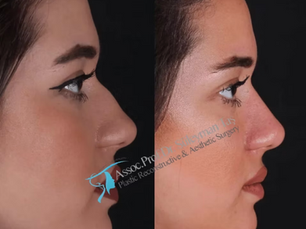 Suleyman Tas Natural Rhinoplasty Before After Results