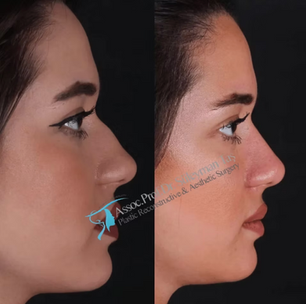 Suleyman Tas Natural Rhinoplasty Before After Results