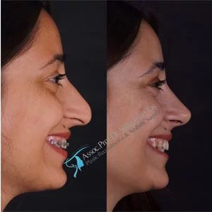 Suleyman Tas Before After Rhinoplasty