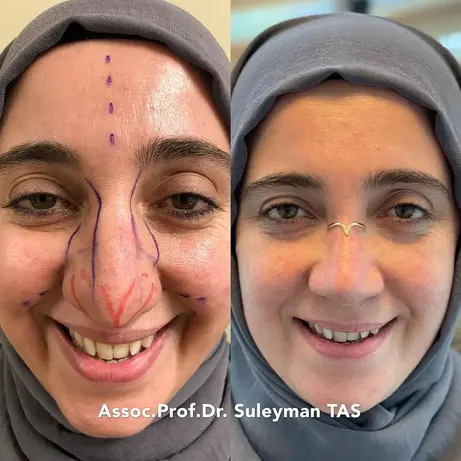 Case Study Number 11 – Septo Rhinoplasty