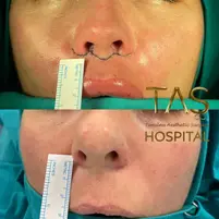 Case Study Number 22 – Lip Lift