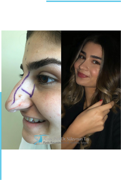 Profiloplasty: What is Profile Aesthetics?