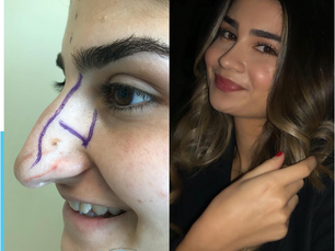 Profiloplasty: What is Profile Aesthetics?