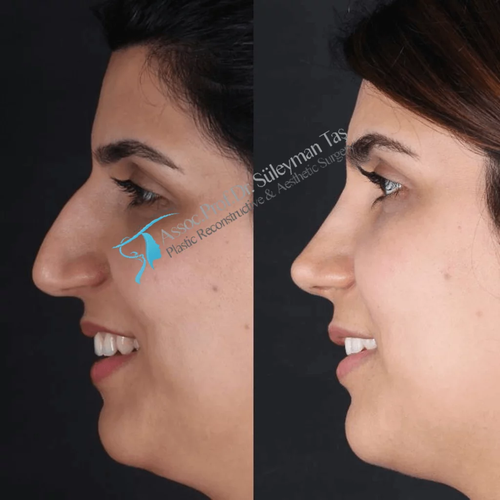 Suleyman Tas Before After Rhinoplasty